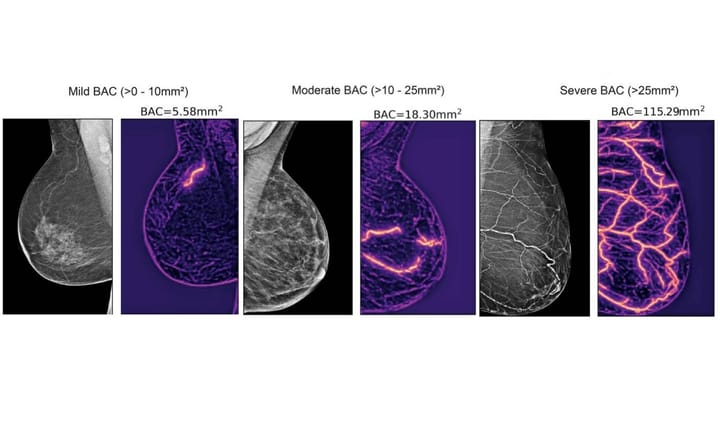 New AI Technology Uses Mammograms to Predict Cardiovascular Risk